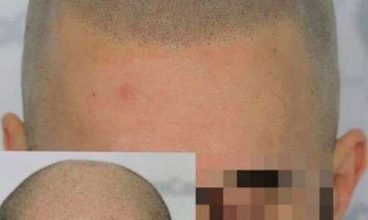 Com a micropigmentação capilar restauramos a linha frontal, micropigmentamos tod…